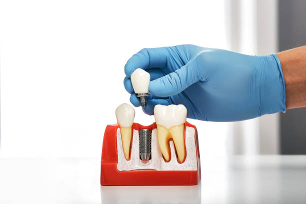 dentist showing the installation of a dental implant on the anatomical model of teeth, close-up